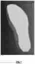 Fig. 08 - Custom foot orthotic and system and method for designing of a custom foot orthotic