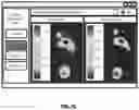Fig. 11 - Custom foot orthotic and system and method for designing of a custom foot orthotic