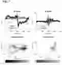 Fig. 11 - SYSTEMS AND METHODS OF AUTOMATIC COUGH IDENTIFICATION