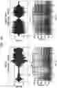 Fig. 16 - Apparatus and method for identification of wheezing in ausculated lung sounds