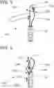 Fig. 05 - Interventional device for specimen retrieval