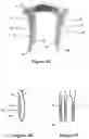 Fig. 07 - Bone distractor