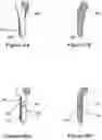 Fig. 22 - Bone distractor