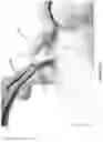 Fig. 26 - Bone distractor