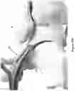 Fig. 27 - Bone distractor