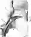 Fig. 28 - Bone distractor
