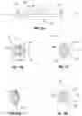 Fig. 10 - Spine stabilization utilizing the uncinate joints