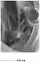 Fig. 02 - Mitral papillary muscle exposure device