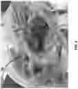 Fig. 04 - Mitral papillary muscle exposure device