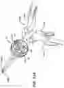 Fig. 15 - Methods and devices for providing access into a body cavity