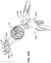 Fig. 17 - Methods and devices for providing access into a body cavity