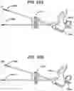 Fig. 22 - Methods and devices for providing access into a body cavity