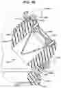 Fig. 44 - Methods and devices for providing access into a body cavity