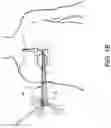 Fig. 03 - Prosthetic suturing device and methods thereof