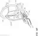 Fig. 28 - Prosthetic suturing device and methods thereof