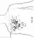 Fig. 64 - Prosthetic suturing device and methods thereof