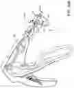 Fig. 71 - Prosthetic suturing device and methods thereof