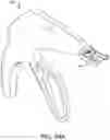 Fig. 82 - Prosthetic suturing device and methods thereof