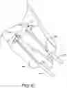 Fig. 90 - Prosthetic suturing device and methods thereof