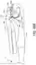 Fig. 92 - Prosthetic suturing device and methods thereof