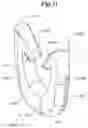 Fig. 35 - Mechanical method and apparatus for bilateral tissue fastening