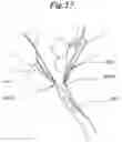 Fig. 41 - Mechanical method and apparatus for bilateral tissue fastening