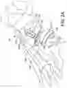 Fig. 04 - Guidance system for hallux valgus correction
