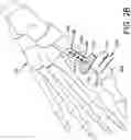 Fig. 05 - Guidance system for hallux valgus correction