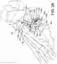 Fig. 06 - Guidance system for hallux valgus correction