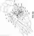 Fig. 13 - Guidance system for hallux valgus correction