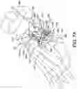 Fig. 15 - Guidance system for hallux valgus correction