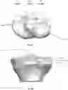 Fig. 11 - Tibial guides, tools and techniques for resecting the tibial plateau