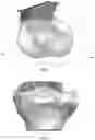 Fig. 13 - Tibial guides, tools and techniques for resecting the tibial plateau