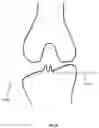 Fig. 15 - Tibial guides, tools and techniques for resecting the tibial plateau