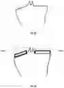 Fig. 16 - Tibial guides, tools and techniques for resecting the tibial plateau