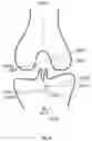 Fig. 17 - Tibial guides, tools and techniques for resecting the tibial plateau