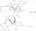 Fig. 15 - Calculus/calculi retrieving device and method