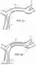 Fig. 17 - Electrically assisted attachment of medical devices to thrombus