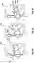 Fig. 12 - Methods and devices for puncturing tissue