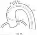 Fig. 11 - Guide extension catheter assemblies, systems and methods of use