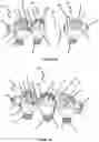 Fig. 12 - Advanced Polyaxial System and Surgical Procedure