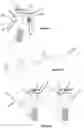 Fig. 13 - Advanced Polyaxial System and Surgical Procedure