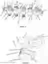 Fig. 14 - Advanced Polyaxial System and Surgical Procedure