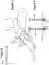 Fig. 04 - PLANTARLY APPLIED REVERSE LOCKING PLATE
