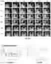 Fig. 16 - System and method for ablating breast cancer cells with cold plasma
