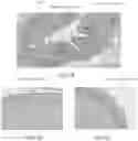 Fig. 05 - Methods, systems and devices for reducing the luminal surface area of the gastrointestinal tract