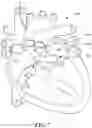 Fig. 08 - Augmented reality solution to optimize the directional approach and therapy delivery of interventional cardiology tools