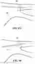 Fig. 09 - Augmented reality solution to optimize the directional approach and therapy delivery of interventional cardiology tools