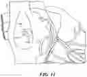 Fig. 15 - Augmented reality solution to optimize the directional approach and therapy delivery of interventional cardiology tools