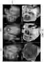 Fig. 16 - Augmented reality solution to optimize the directional approach and therapy delivery of interventional cardiology tools